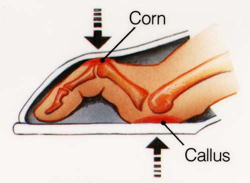 What causes hammertoes and corns?