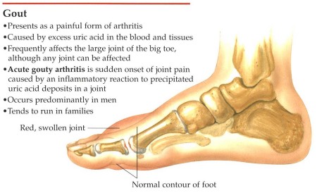 heel pain and uric acid